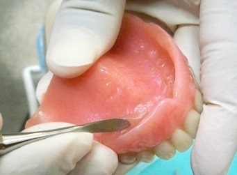 Adding Base to Denture Reline