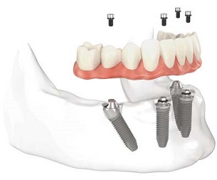 Permanent Dental Implants