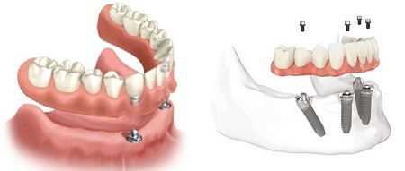 Removable Dentures