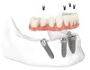 Implant Supported Dentures